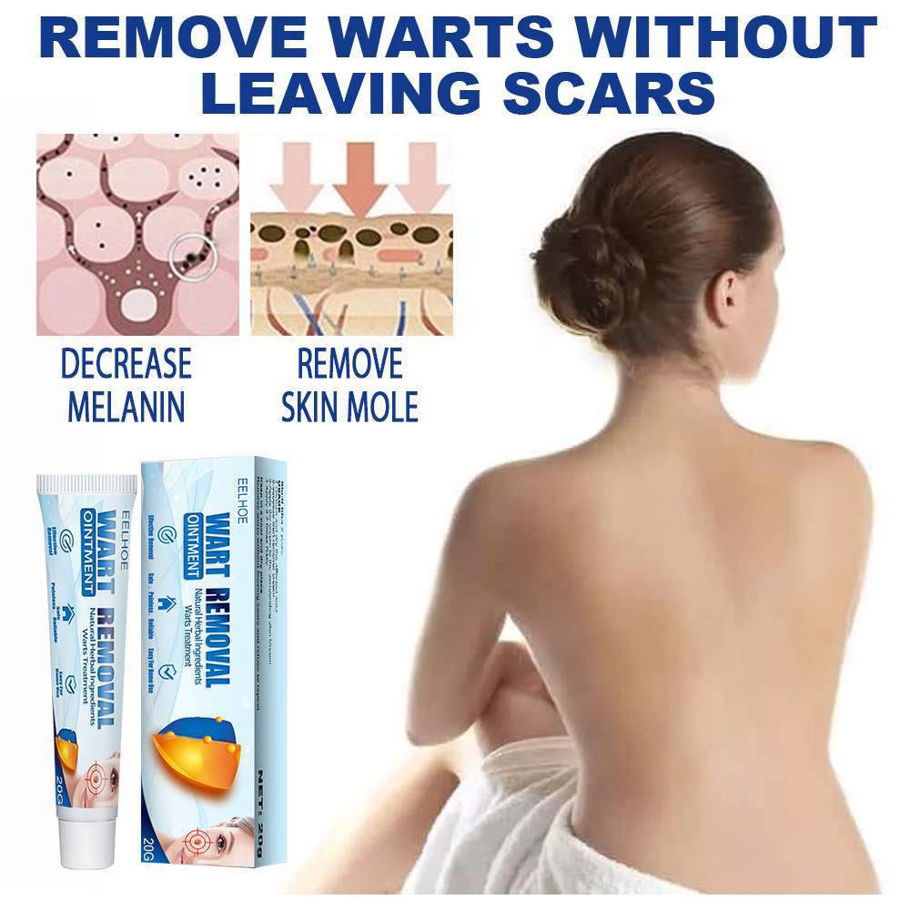 Wart Remover Cream Easy